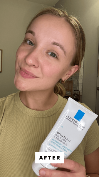 Herrick after using the La RochePosay Effaclar Medicated Gel Cleanser